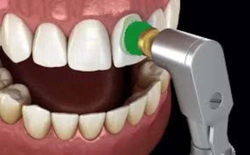 EZ Dental Prophy Polishing Cup, Soft Disposable image indicator(4)