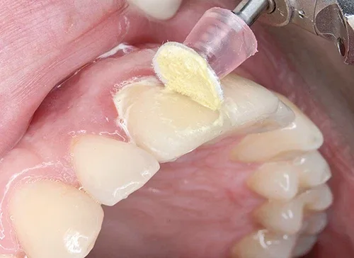 EZ Smile Dental Polisher Finishing Wheel Kit image indicator(4)