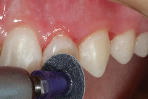 EZ Dental Finishing Polishing Discs+2 Mandrel Kit image indicator(6)