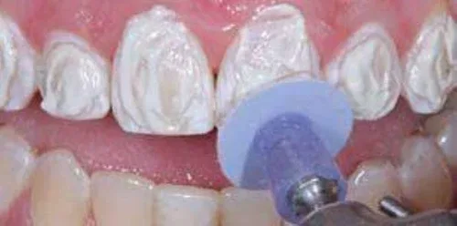 EZ Dental Finishing Polishing Discs+2 Mandrel Kit image indicator(7)