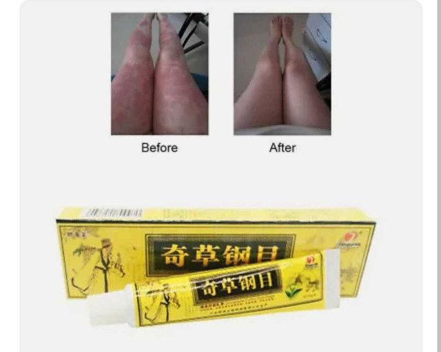 15g Chinese Herbal Cream Itching Treatment - photo 2
