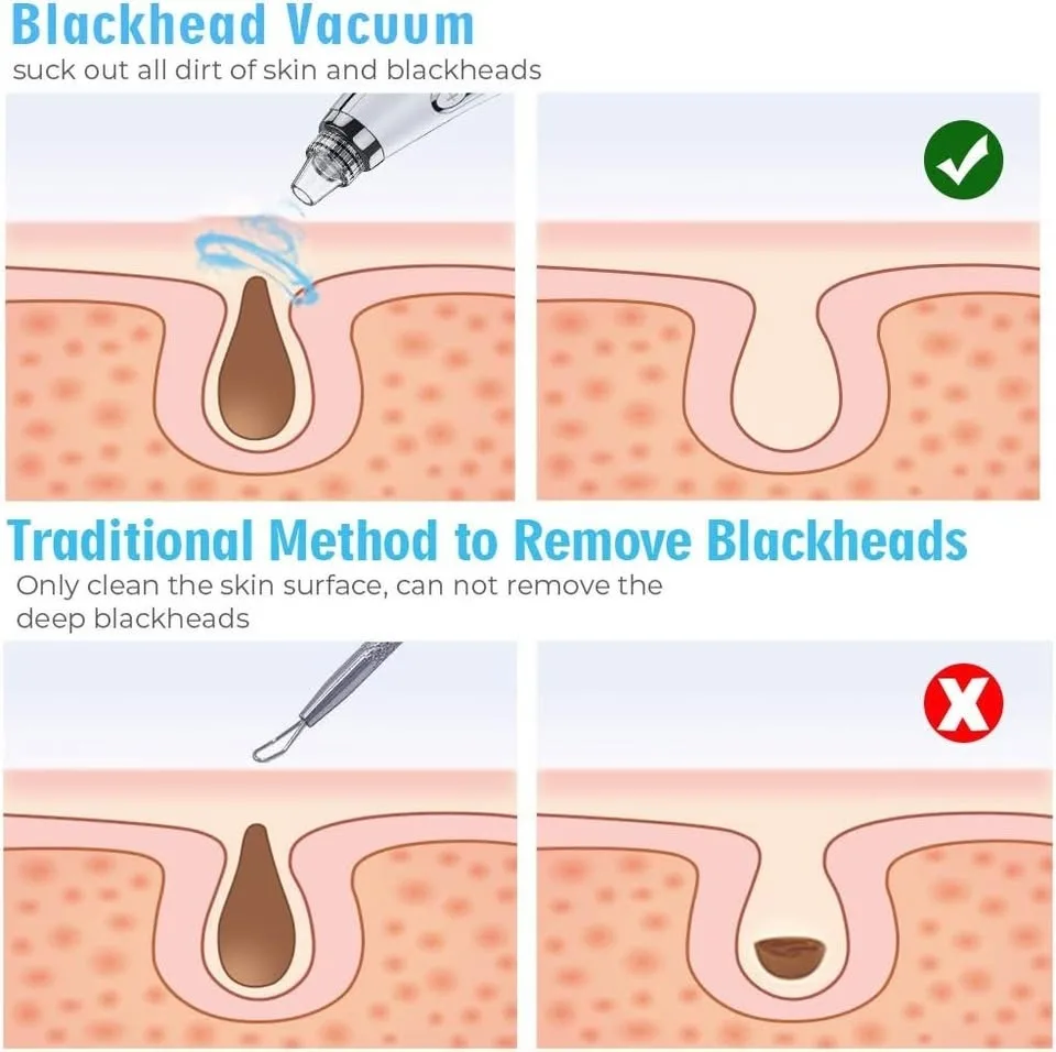 $10 NEW USB Blackhead Remover + Steel Pimple Popper Kit image indicator(5)