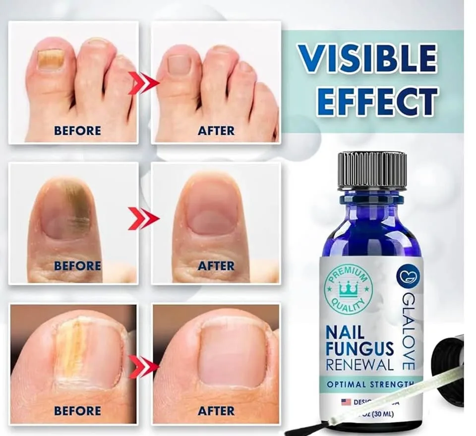 Toenail fungus treatment