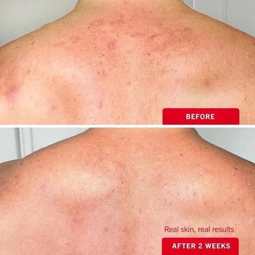 Acne Spray ACNE-EX Body Mist Reduce Dark Spot Neck Arm Pimple 12 - photo 4