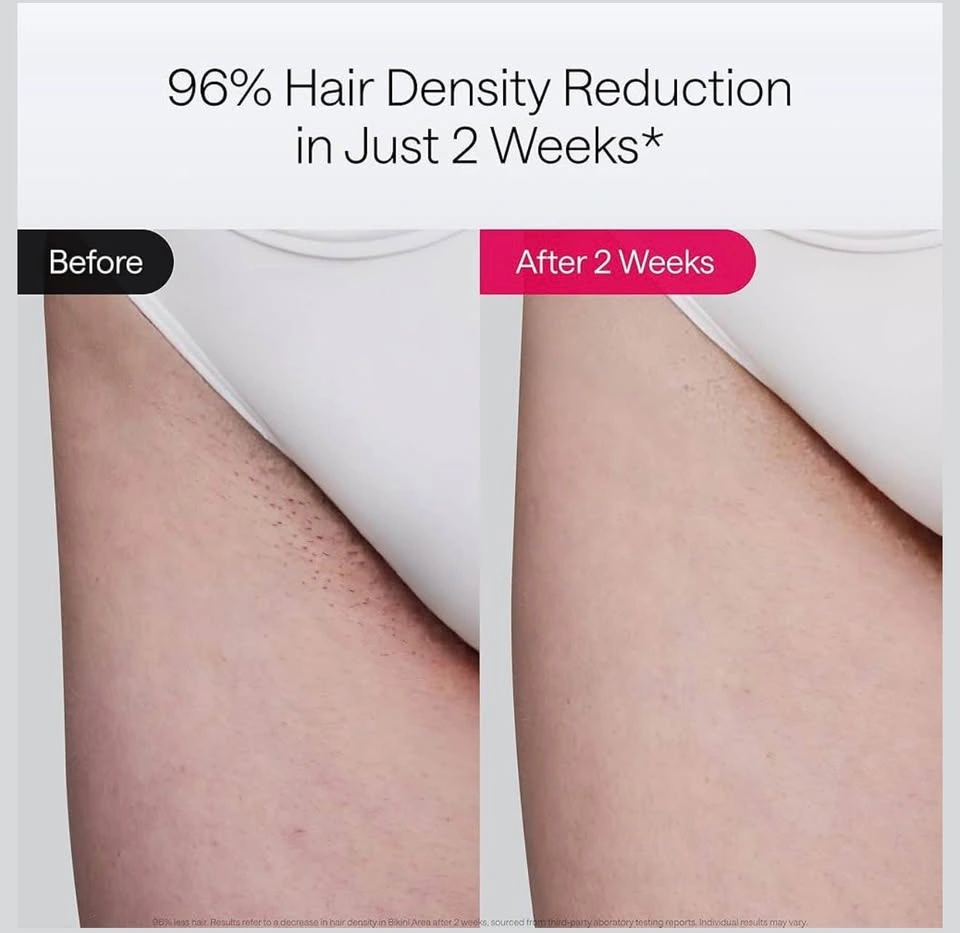 Ulike Laser Hair Removal Air 10 IPL - photo 4