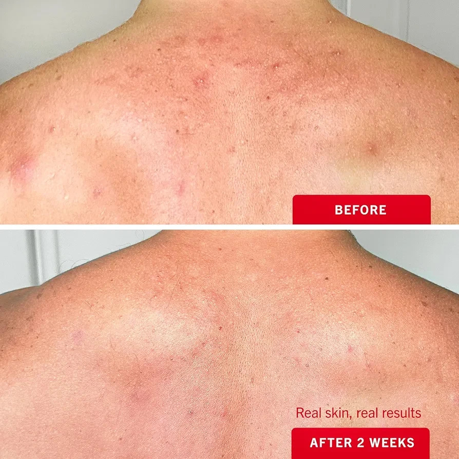 Acne Spray ACNE-EX Body Mist Reduce Dark Spot Neck Arm Pimple 12 - photo 4