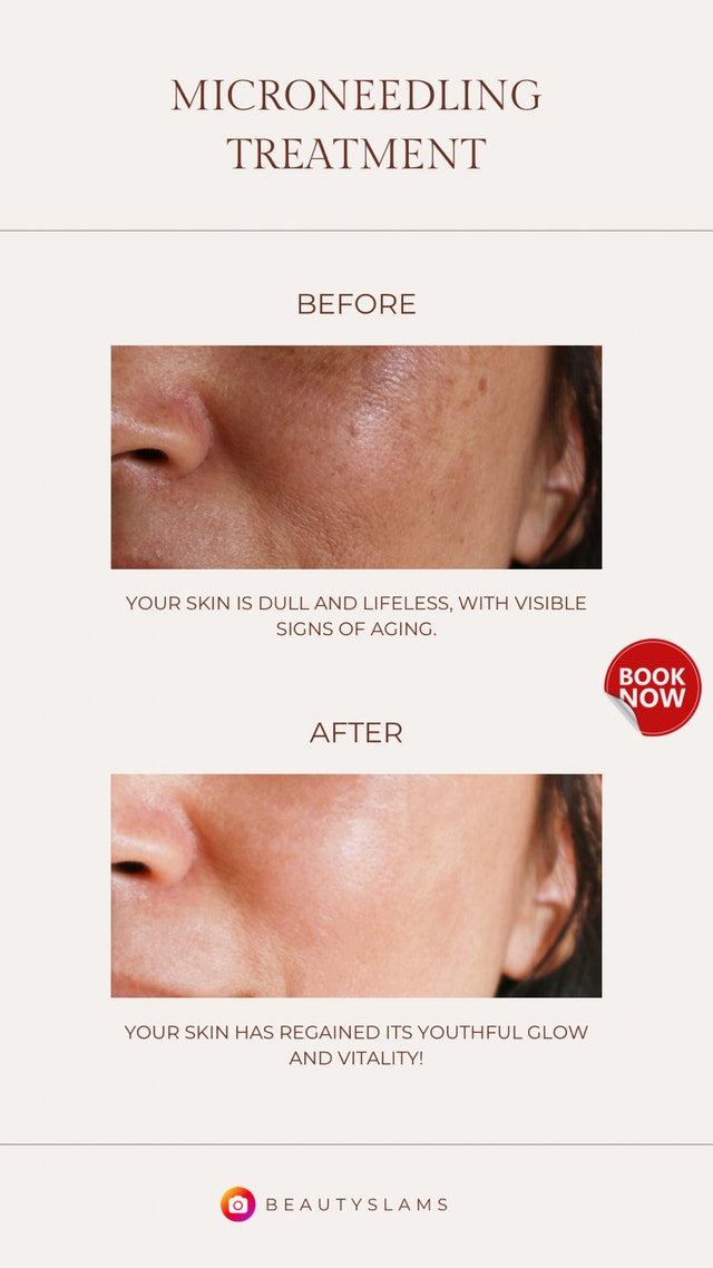 Micro-Needling Facial for women