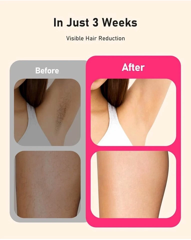 (New) Laser Hair Removal for Women and Men - photo 3