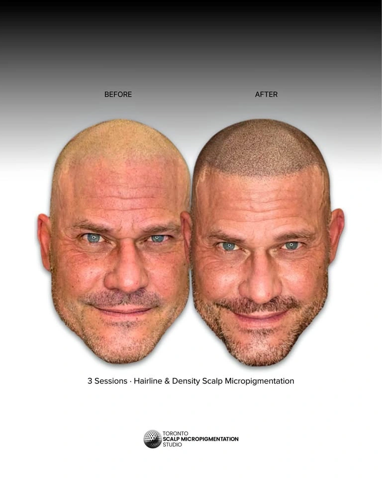 Hair Loss Solution | Scalp Micropigmentation SMP