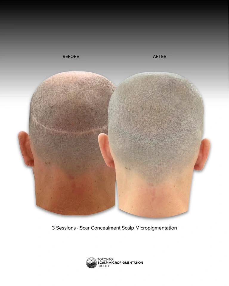 Hair Loss Solution | Scalp Micropigmentation SMP - photo 4