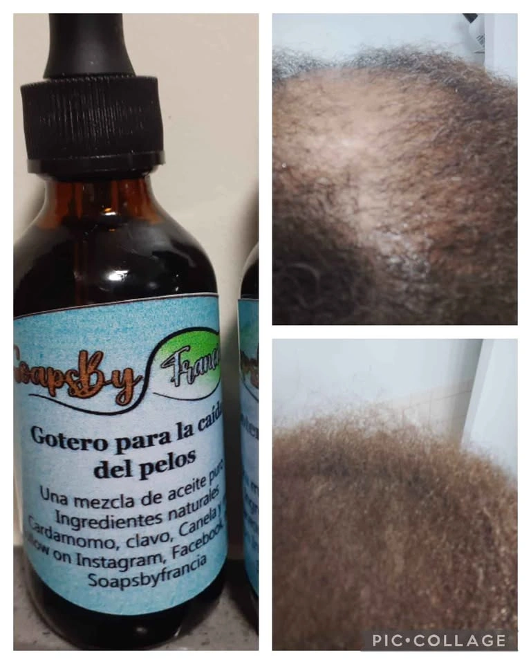 Hair Loss Dropper - photo 4