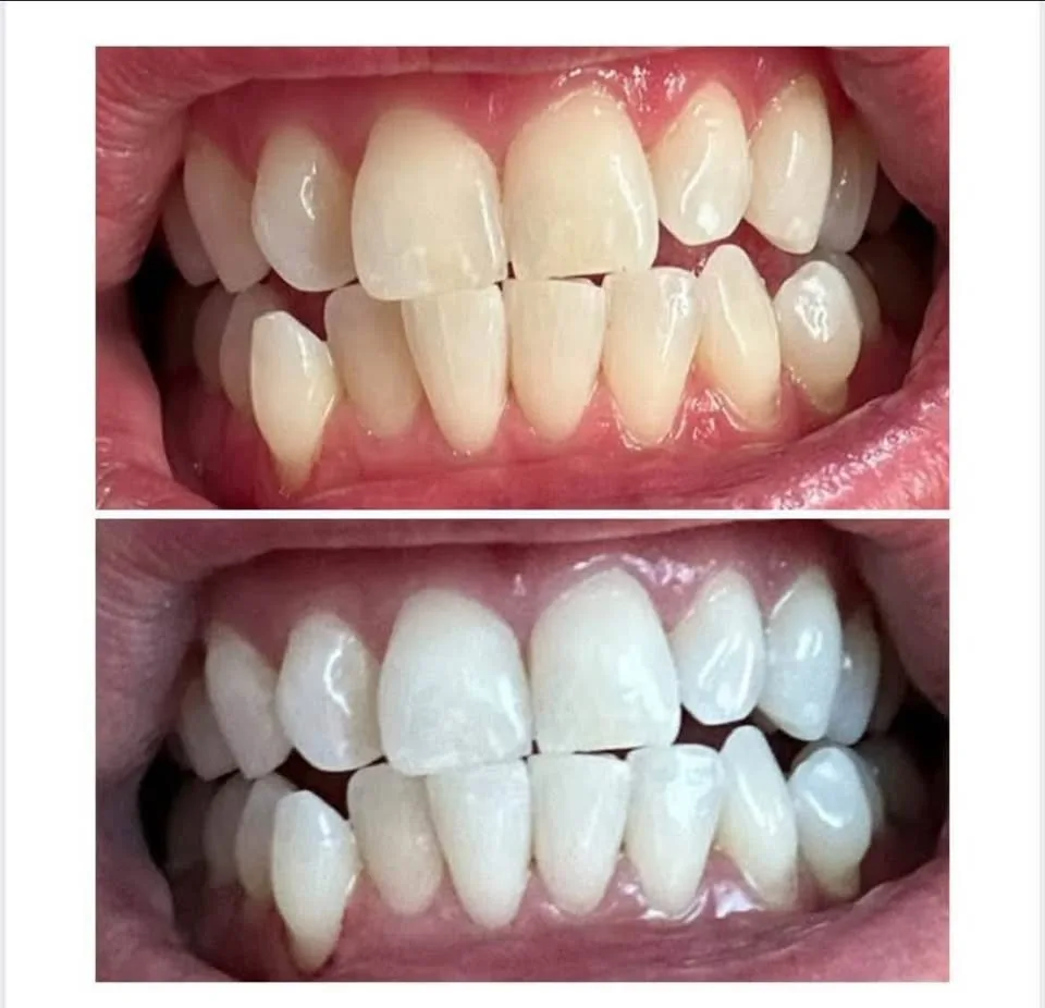 Hismile teeth whitening bundle image indicator(4)