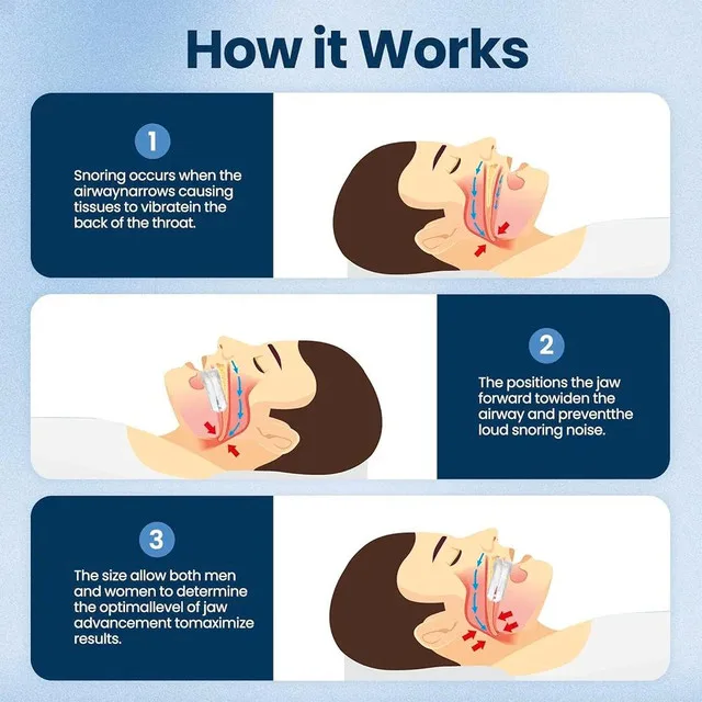 Stop Snoring Devices – Anti Snoring Mouth Guard image indicator(8)