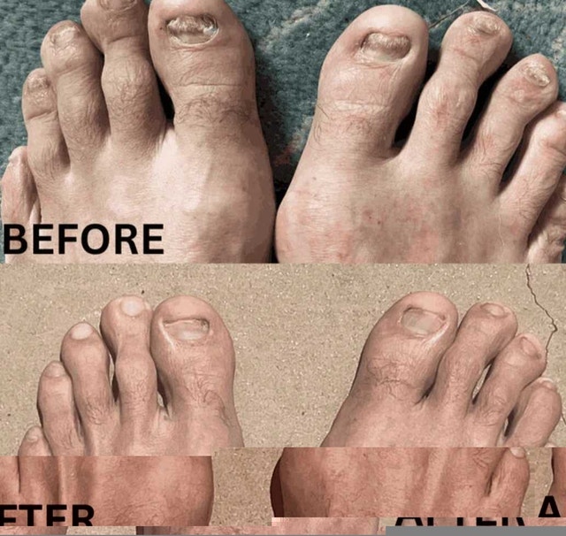 Neoclear Nail Fungus treatment Device - photo 5