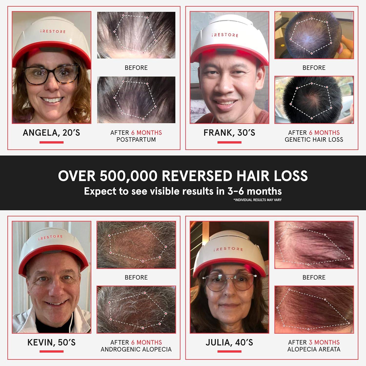 iRestore Professional Laser Hair Growth System-FDA Cleared Laser - photo 2