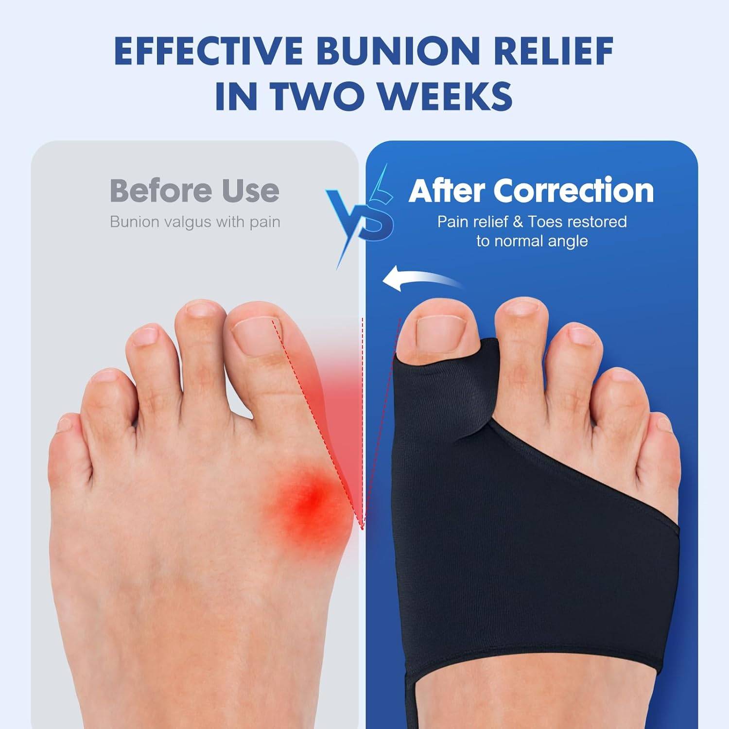 2PCS Bunion Corrector for Women & Men - photo 3
