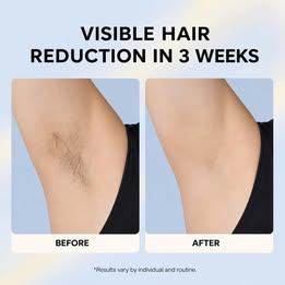 IPL Laser Hair Removal, with Ice Cooling - photo 3