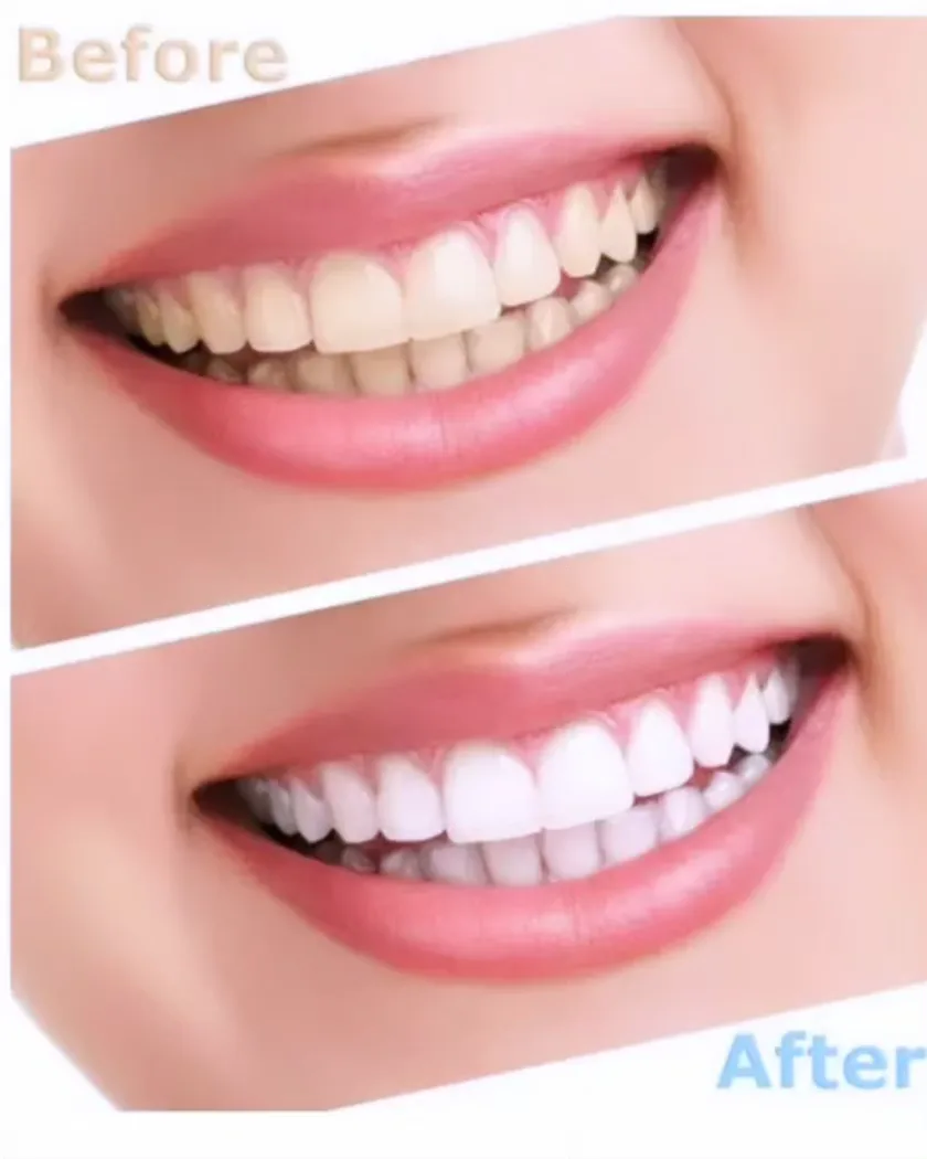 Teeth Whitening treatments thumbnail