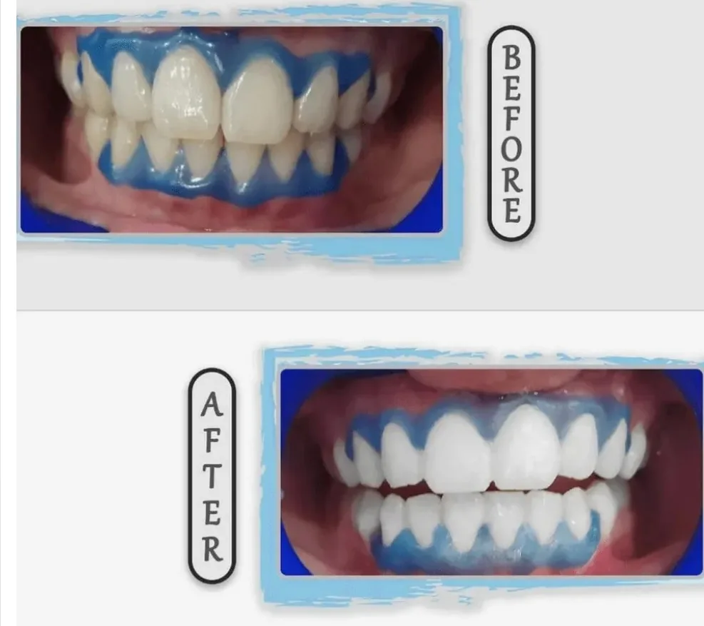 Teeth Whitening thumbnail