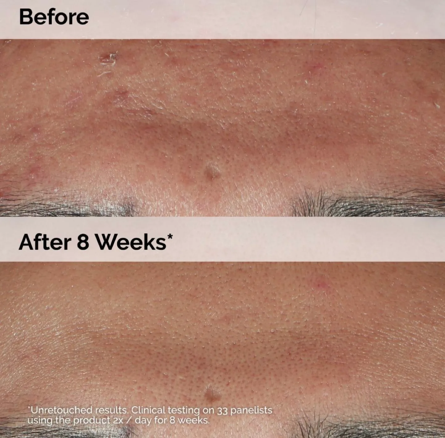 The Ordinary Niacinamide 10% + Zinc 1% Serum image indicator(3)