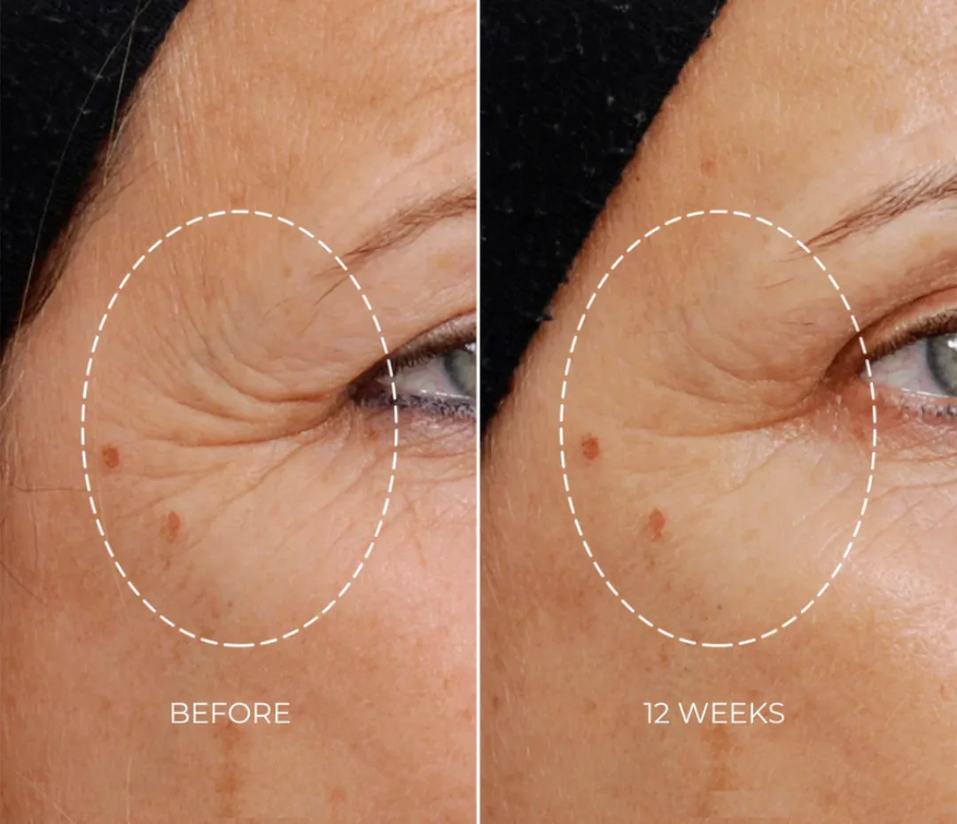 NEWACordless RF Wrinkle Reduction Device image indicator(6)