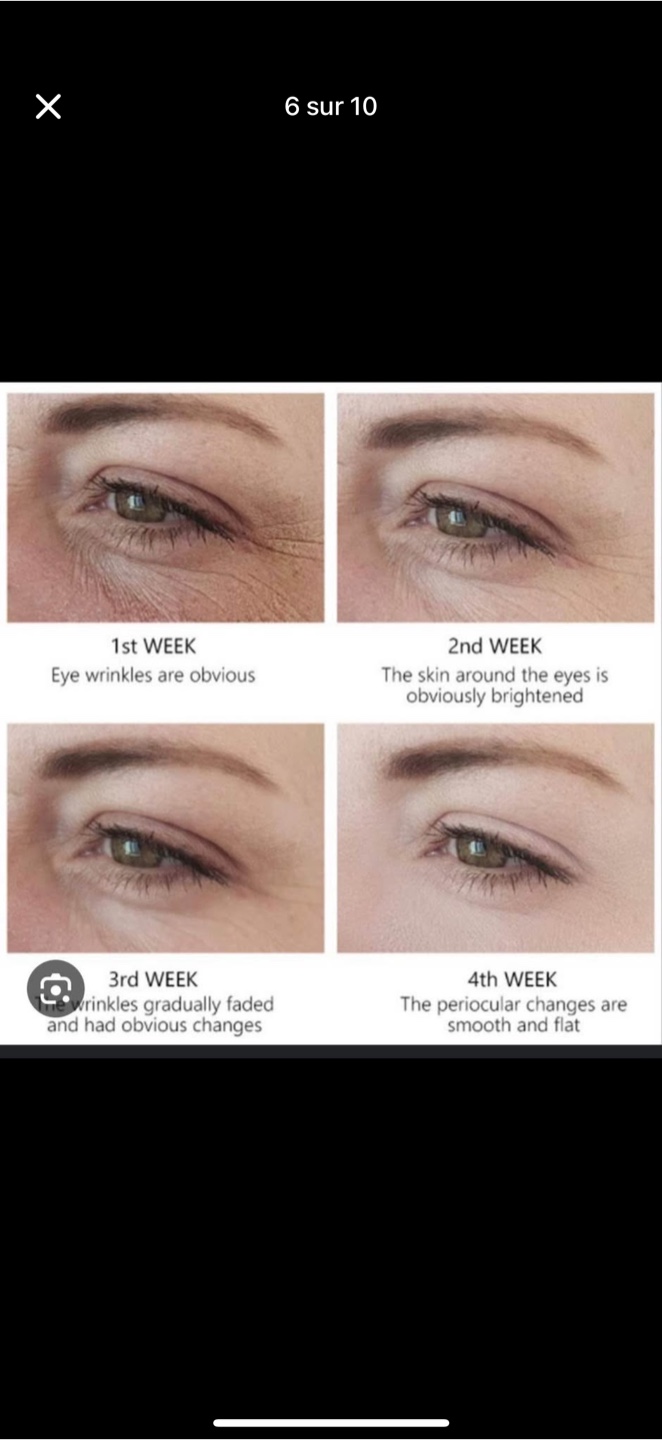 Tria Age-Defying Eye Wrinkle Correcting Laser - photo 4