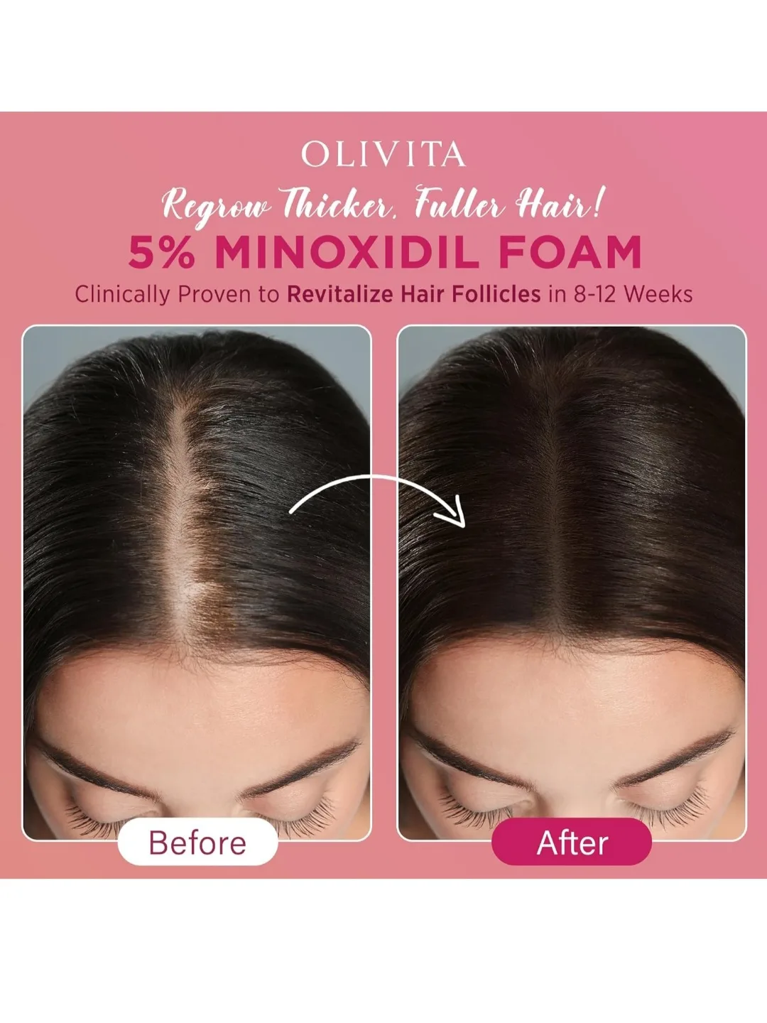 Olivita Minoxidil 5% Foam - 2-Month Supply image indicator(4)