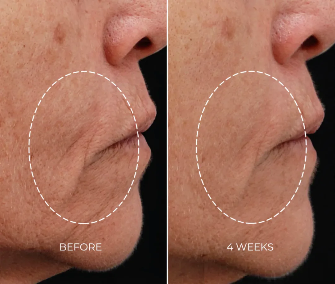 NEWACordless RF Wrinkle Reduction Device image indicator(4)