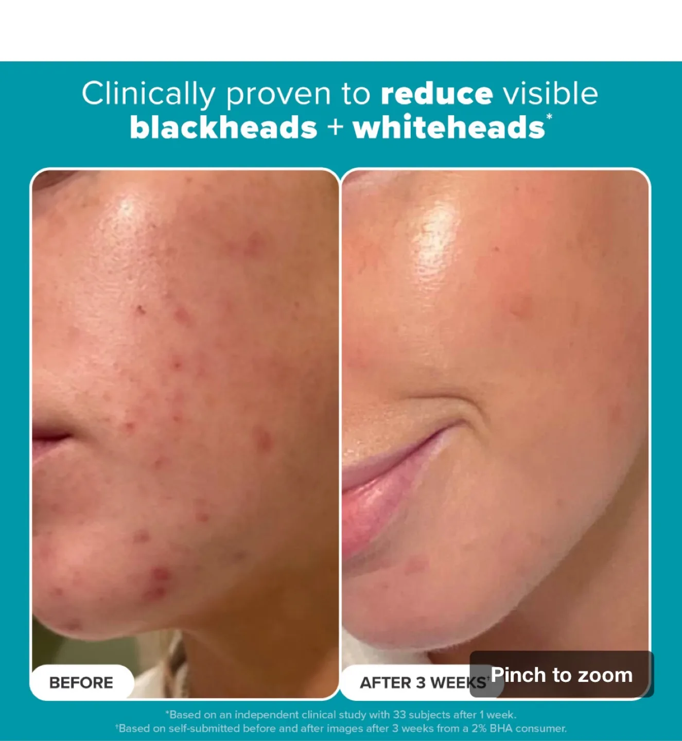 Paula's Choice 2% BHA Liquid Exfoliant image indicator(3)