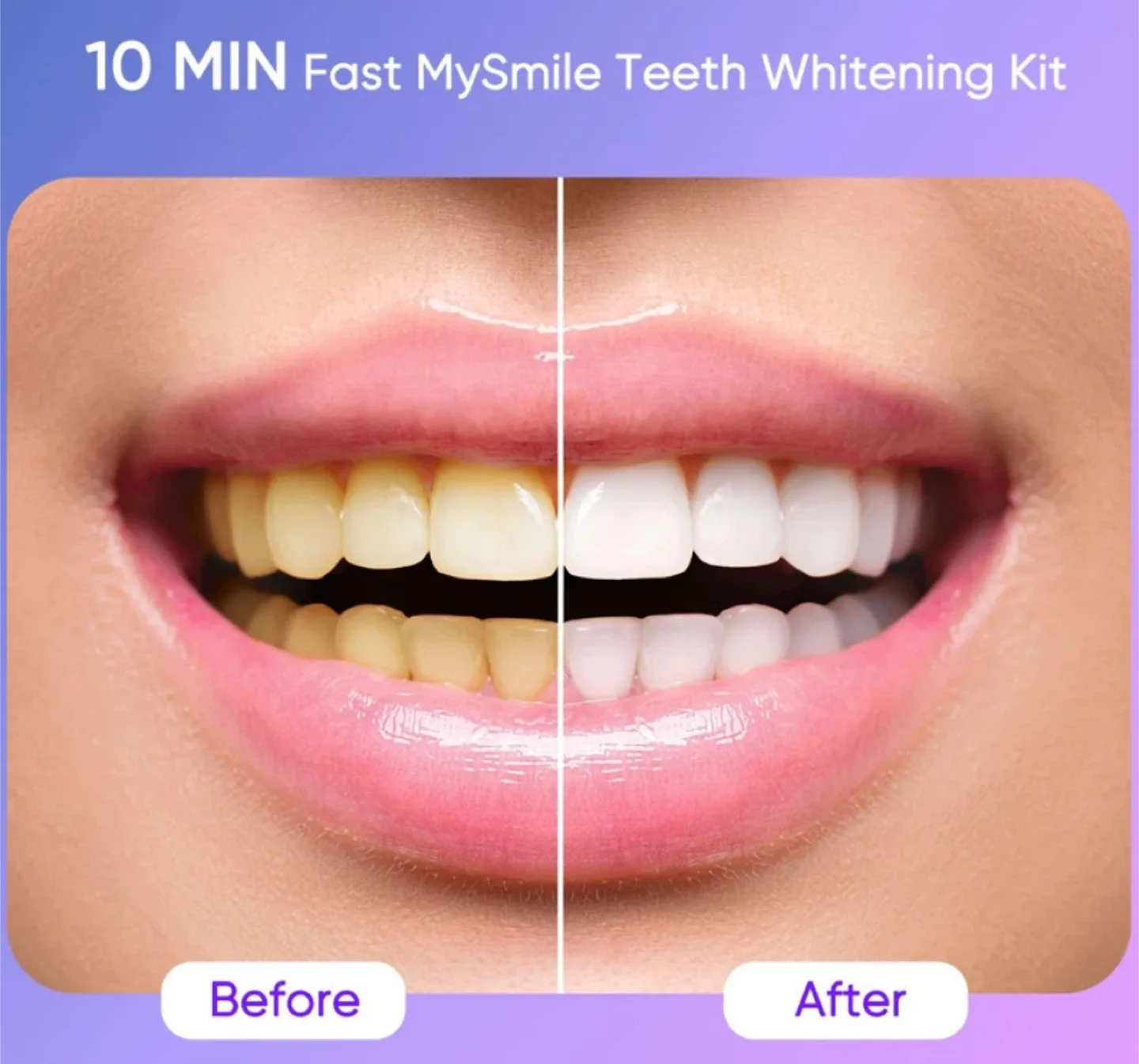 MySmile Ultimate Teeth Whitening Kit - New image indicator(4)