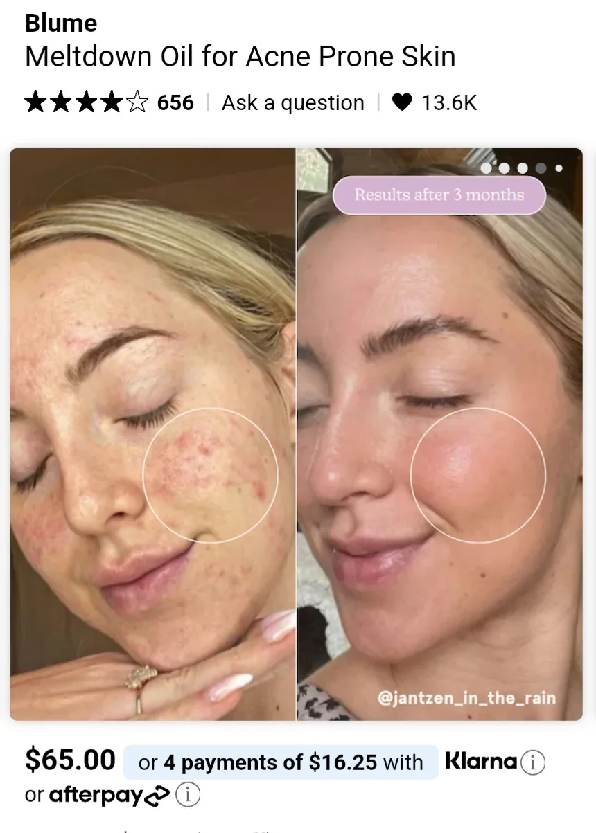 Blume Acne Prone Skin Oil image indicator(5)