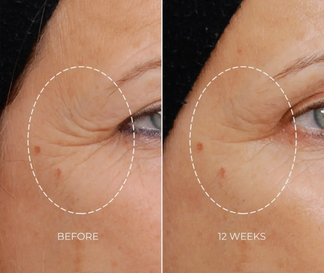 NEWA Plus Cordless RF Wrinkle Reduction Device image indicator(3)