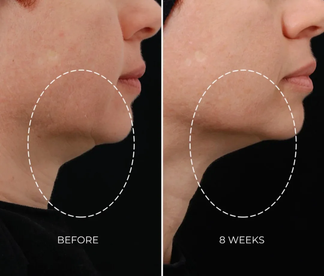 NEWA Plus Cordless RF Wrinkle Reduction Device image indicator(2)