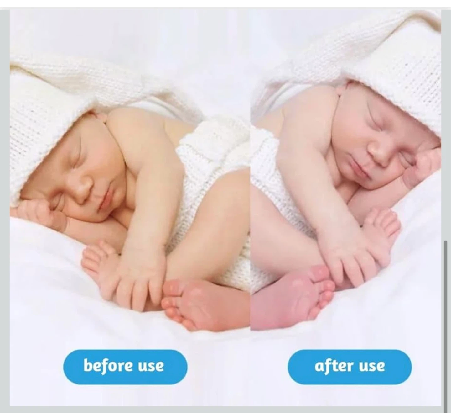 Jaundice Light therapy baby - photo 3