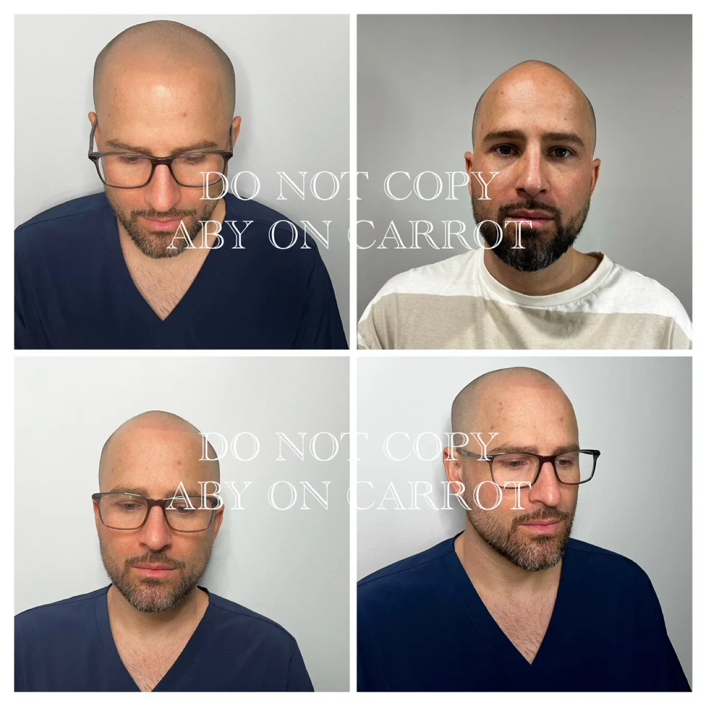 THICKER HAIR AND HAIRLINE TREATMENTS VIA SMP image indicator(5)