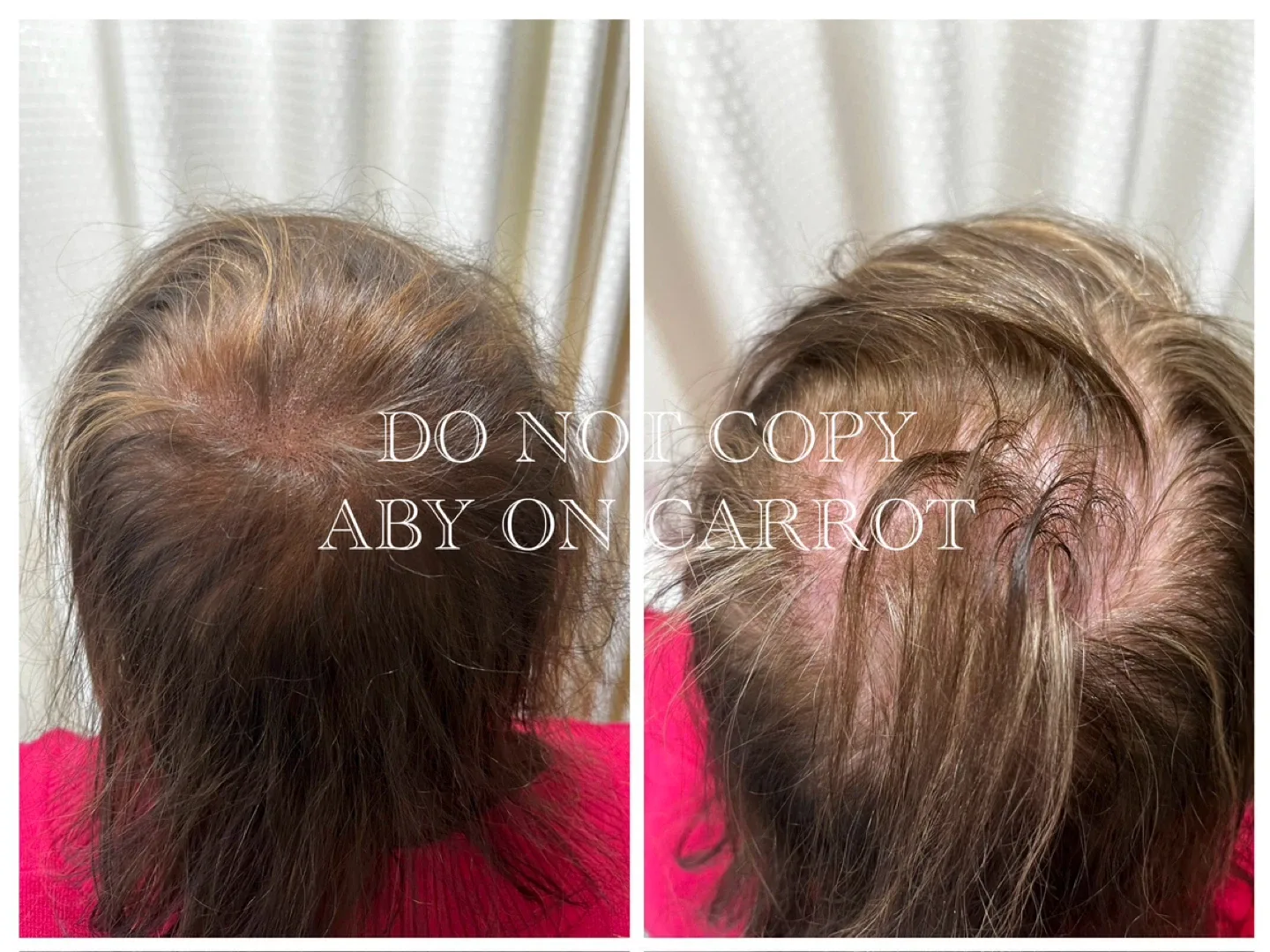 THICKER HAIR AND HAIRLINE TREATMENTS VIA SMP image indicator(3)