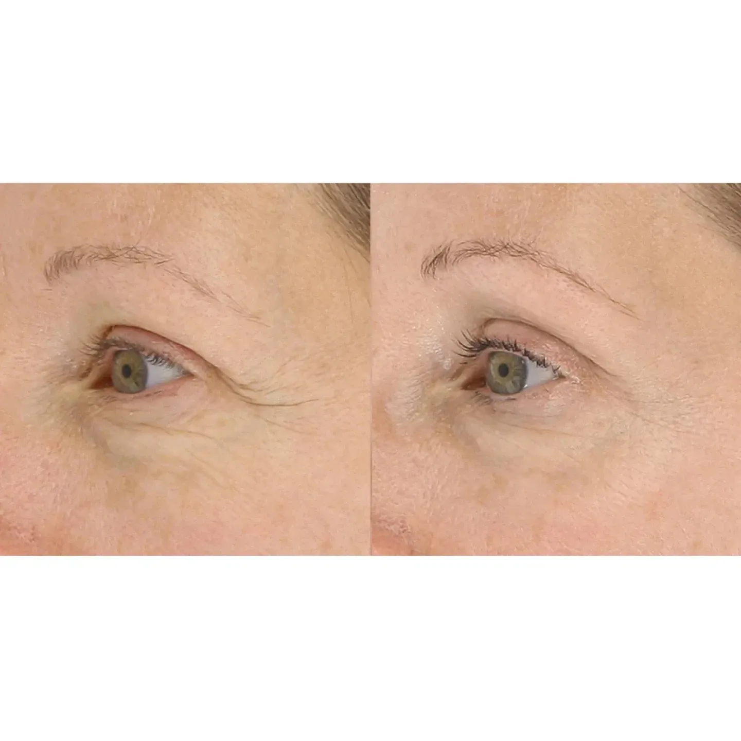 LightStim for wrinkles image indicator(3)