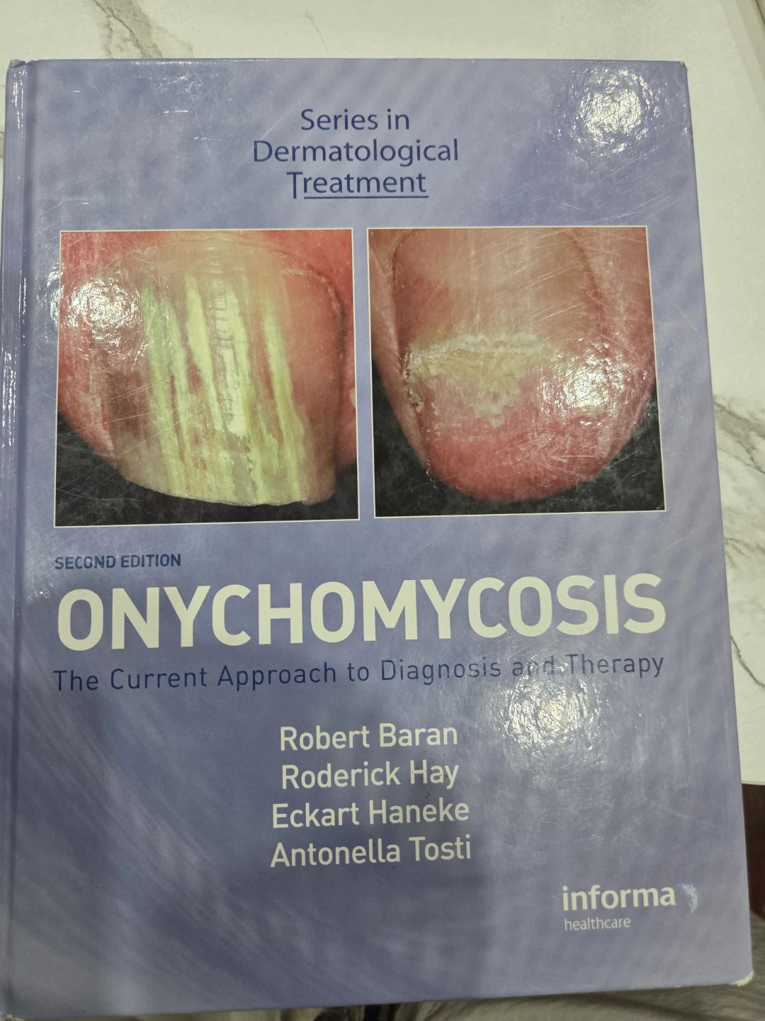 Onychomycosis: The Current Diagnosis and Therapy By Robert Baran
