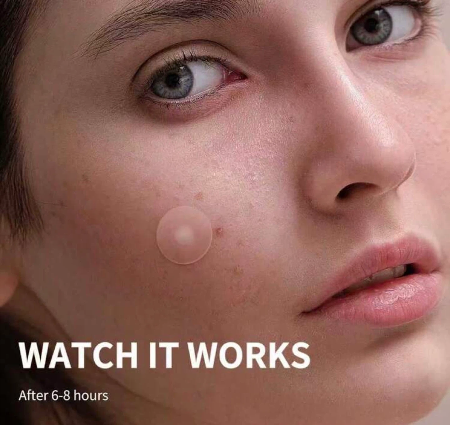 720pcs Face Care Acne Patch - photo 2