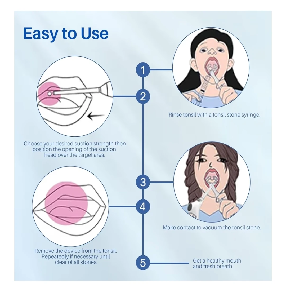 SACL Tonsil Stone Vacuum System Removal Kit 🥕 - photo 5