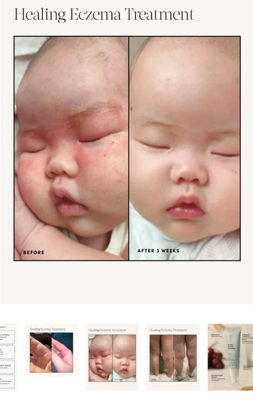 Eczema Relief Cream - photo 2