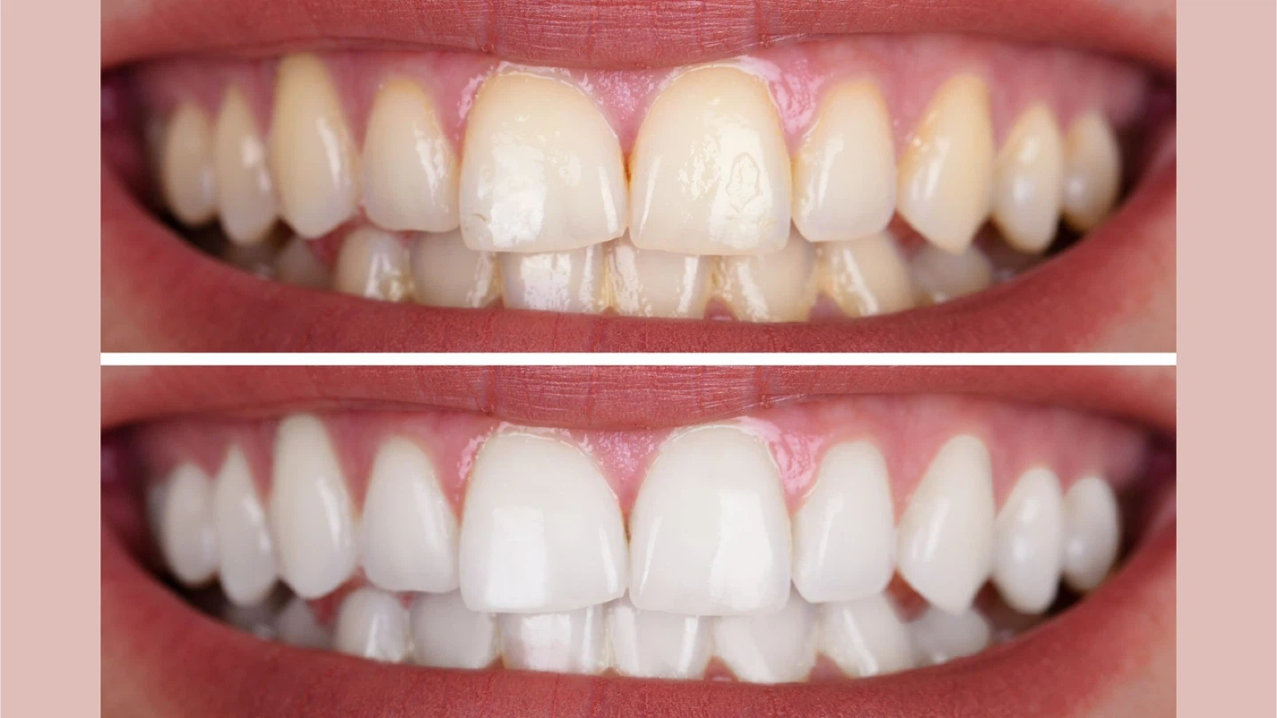 Mobile teeth whitening