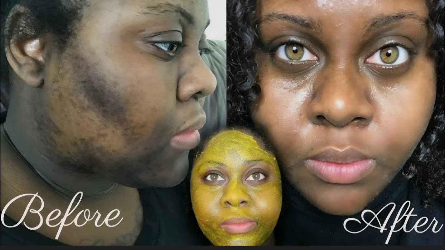 Acne & Dark Spots? Glow in 7 Days or Don’t Pay (Qasil Jar) - photo 5