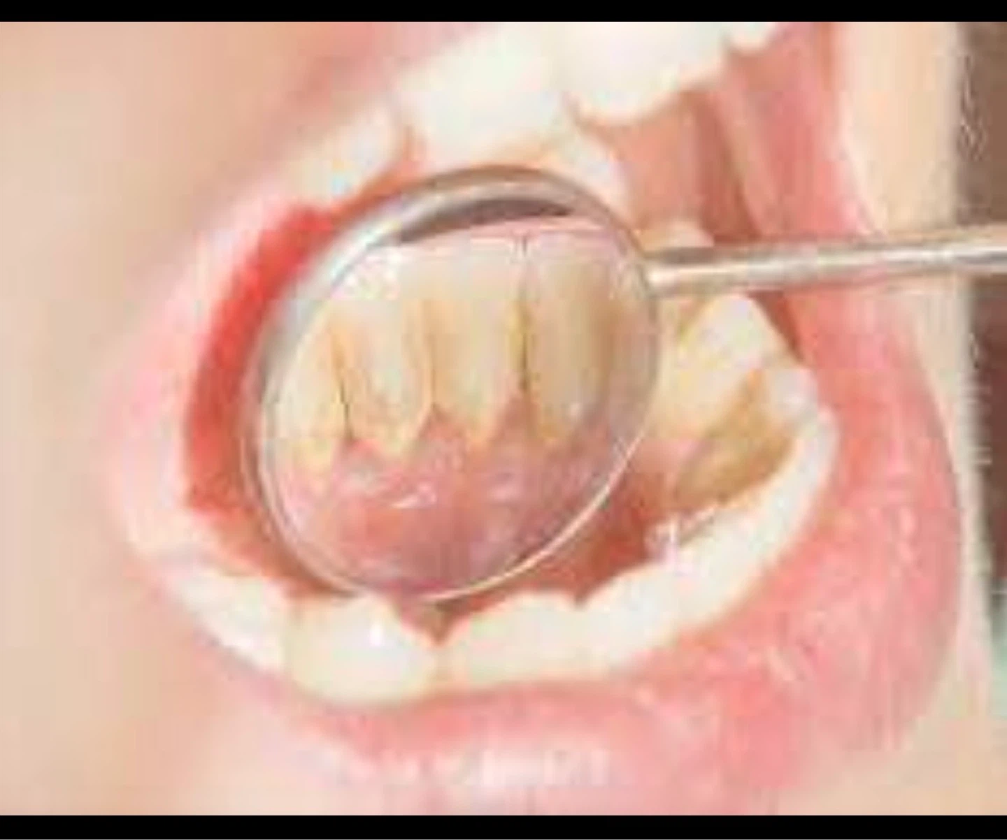 FREE DENTAL CLEANING BY DENTAL HYGIENE STUDENT + CASH REWARD - photo 2