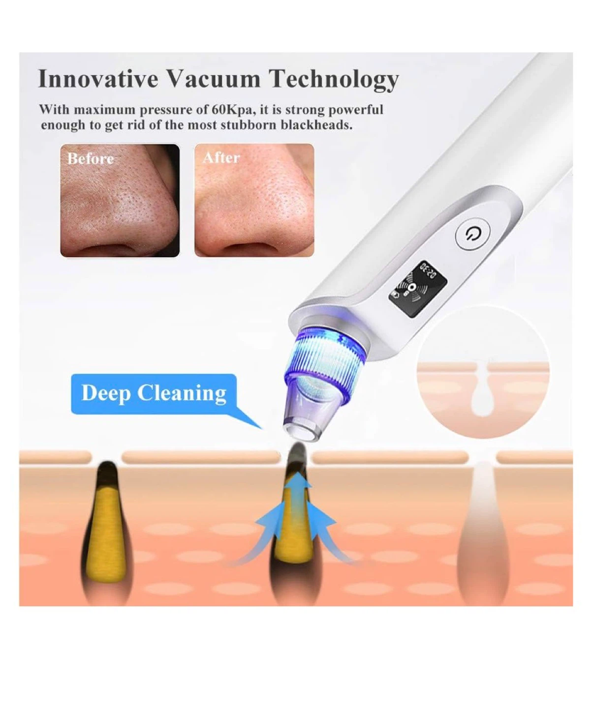 Blackhead remover - photo 3