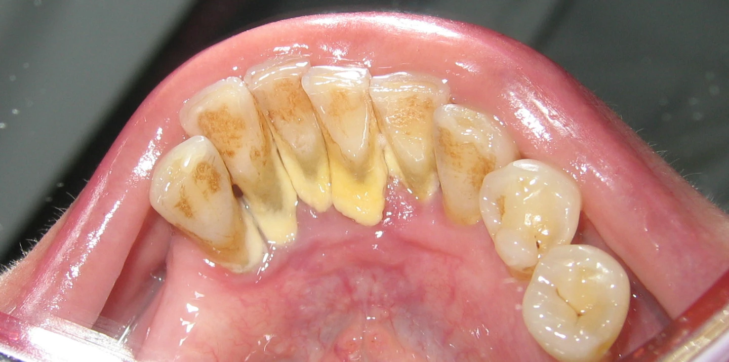 Get $300 Off on your Teeth Cleaning