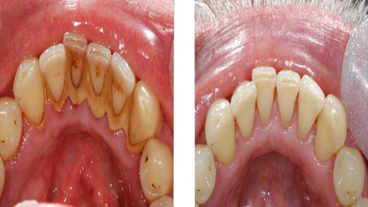Get $300 Off on your Teeth Cleaning - photo 2