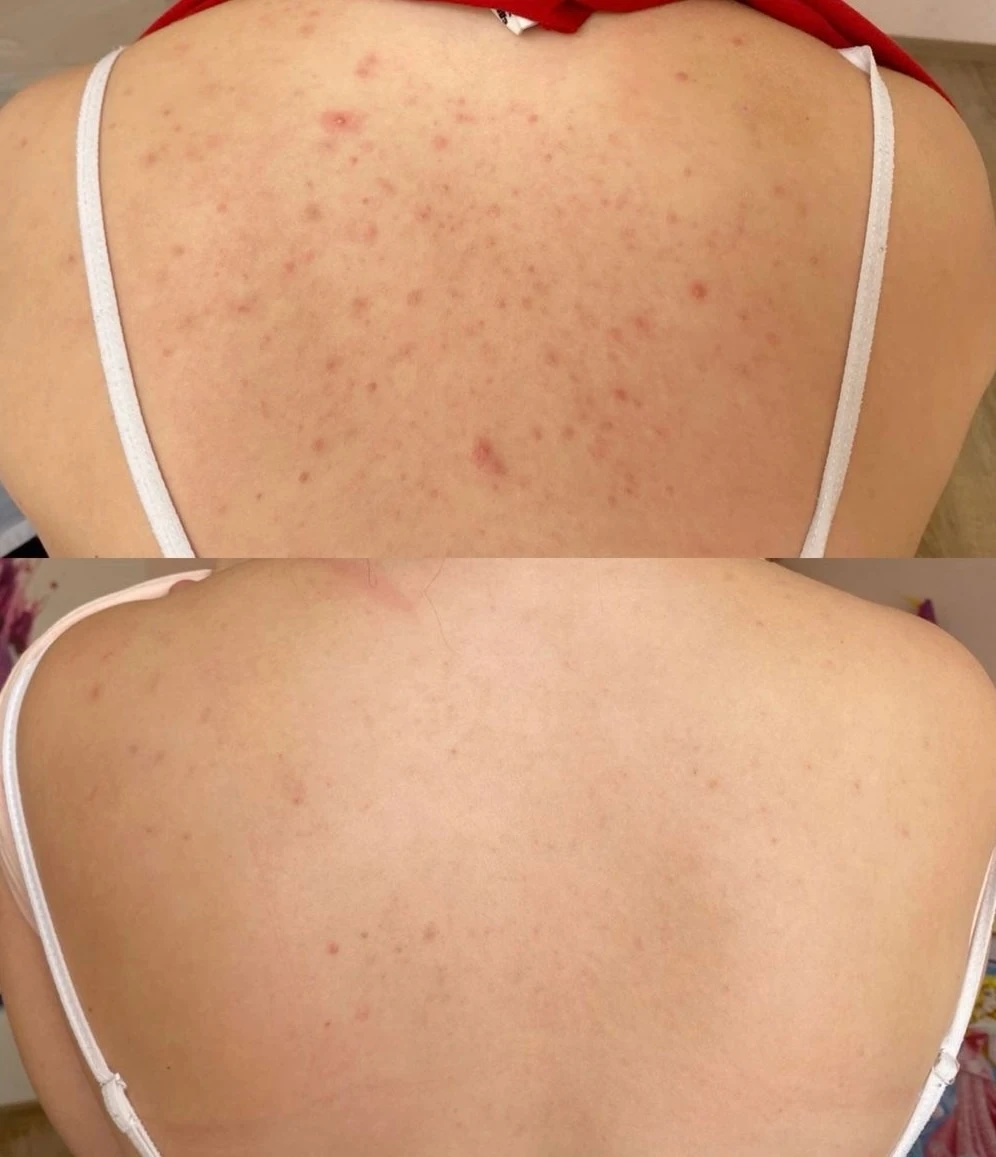 Back Acne Treatment