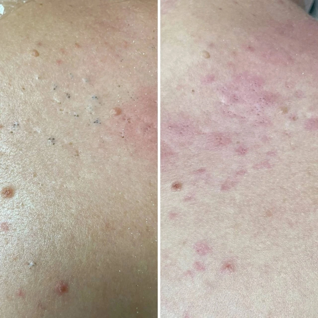 Back Acne Treatment - photo 2