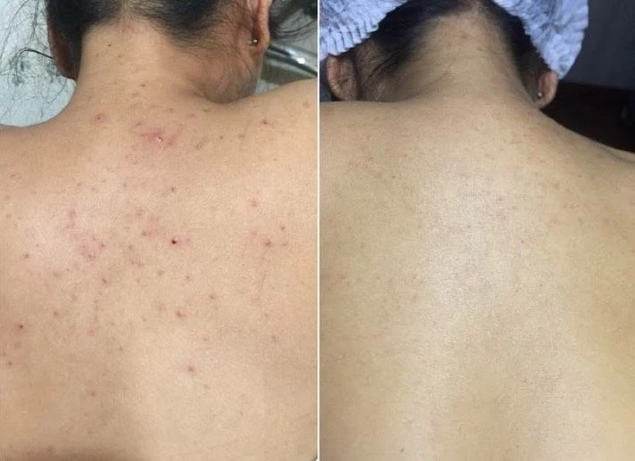 Back Acne Treatment - photo 3